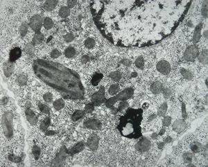 M,15y. | Wilson disease - megamitochondria M,15y. | Wilson disease - megamitochondria